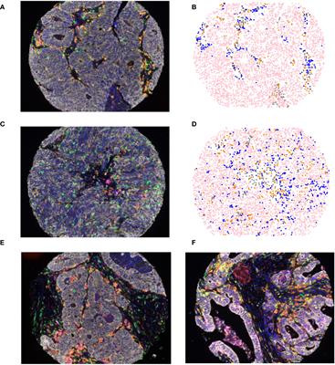 Unique characteristics of the tumor immune microenvironment in young patients with metastatic colorectal cancer